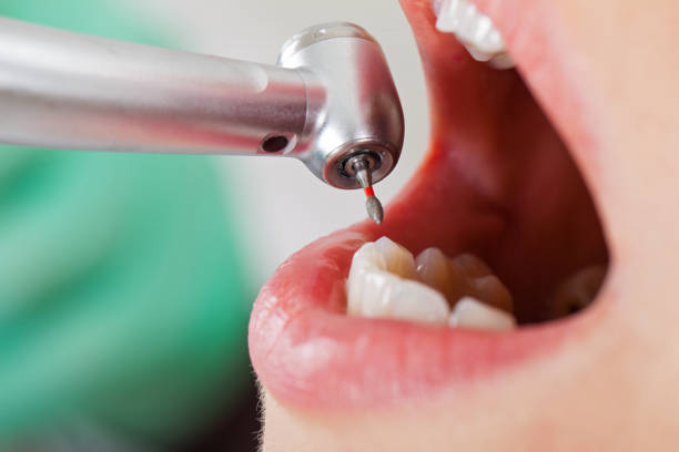 Best Emergency Root Canal Treatment in Westmoreland, TN